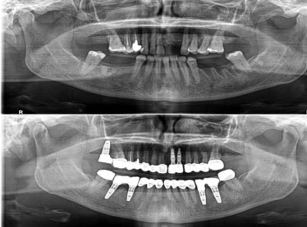 Dental Implant