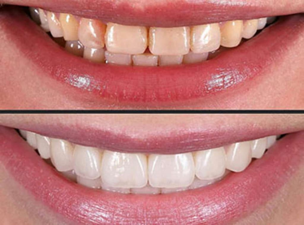 Dental Veneer