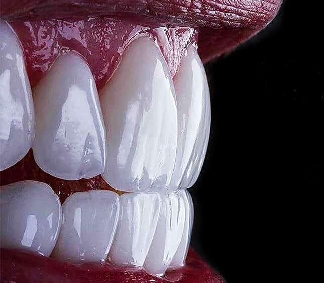 dental veneer